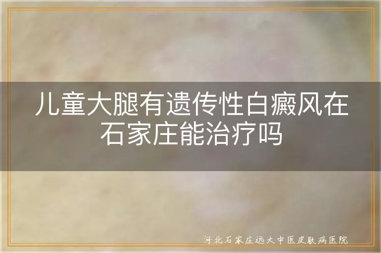 儿童遗传性白癜风治疗,石家庄白癜风医院,白斑专业治疗,白癜风专科医院