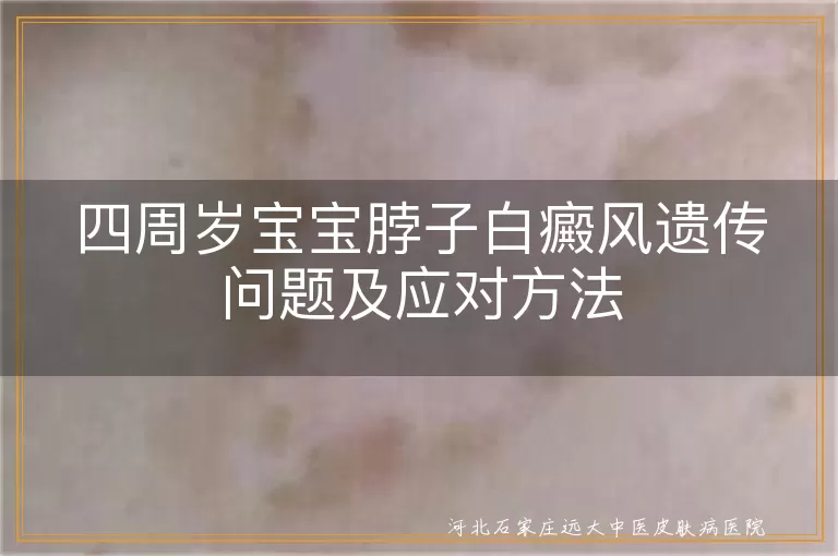 宝宝白癜风遗传几率,四岁儿童白斑应对方法,白癜风治疗与护理,儿童白癜风预防小贴士