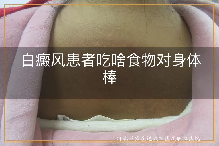 白癜风患者饮食建议,白斑患者吃什么好,白癜风食物疗法,白斑饮食调理