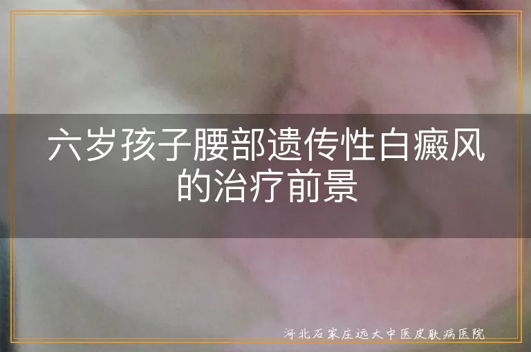 六岁孩子遗传性白癜风治疗,腰部白癜风能否治好,儿童遗传性白斑病治疗,遗传性白癜风治疗方法