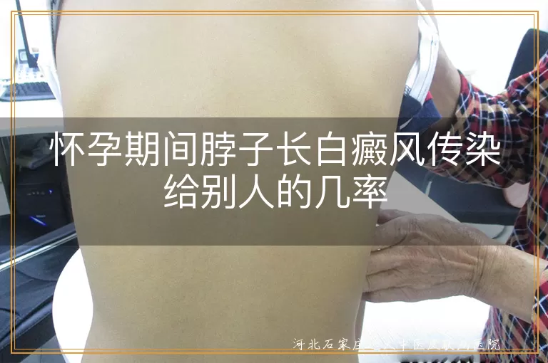 怀孕期间白癜风传染概率,白癜风遗传几率,白斑病是否会传染,白斑病遗传风险