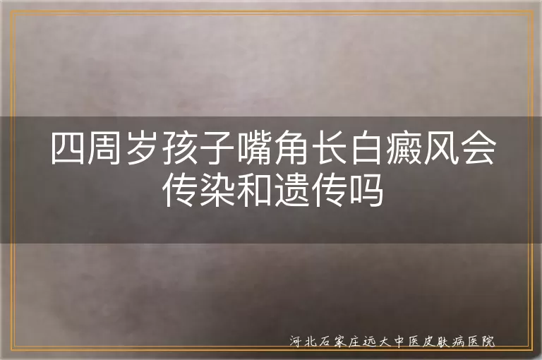 儿童白癜风遗传几率, 白癜风遗传与环境因素, 白癜风不传染需理解, 白斑遗传风险