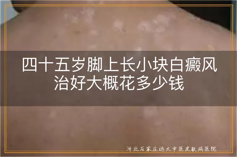 白癜风治疗费用预估,小块白斑治疗花费,白斑治疗省钱方法,脚上白癜风治疗价格