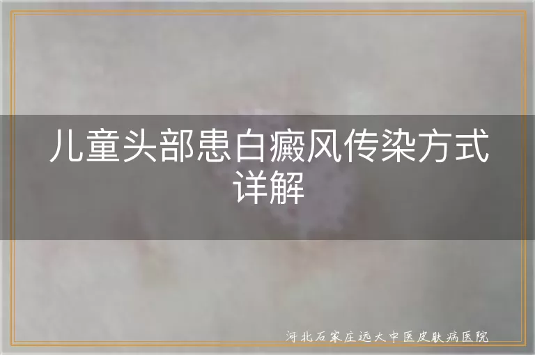 儿童白癜风传染方式,白癜风扩散预防,儿童白斑治疗方法,白斑病因分析