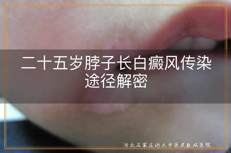白癜风传染途径解析,白斑扩散原因揭秘,白癜风日常护理指南,25岁白癜风治疗方法
