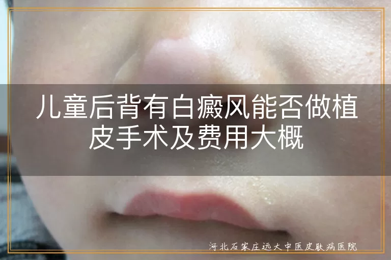 儿童白癜风植皮手术费用,白癜风植皮多少钱,白斑植皮手术条件,儿童白斑治疗方法