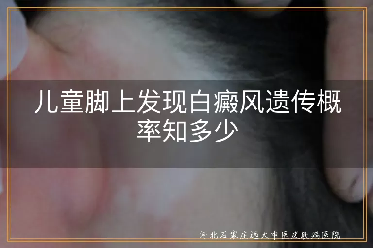 儿童白癜风遗传概率, 白癜风遗传倾向, 白斑遗传风险, 白癜风遗传与环境因素