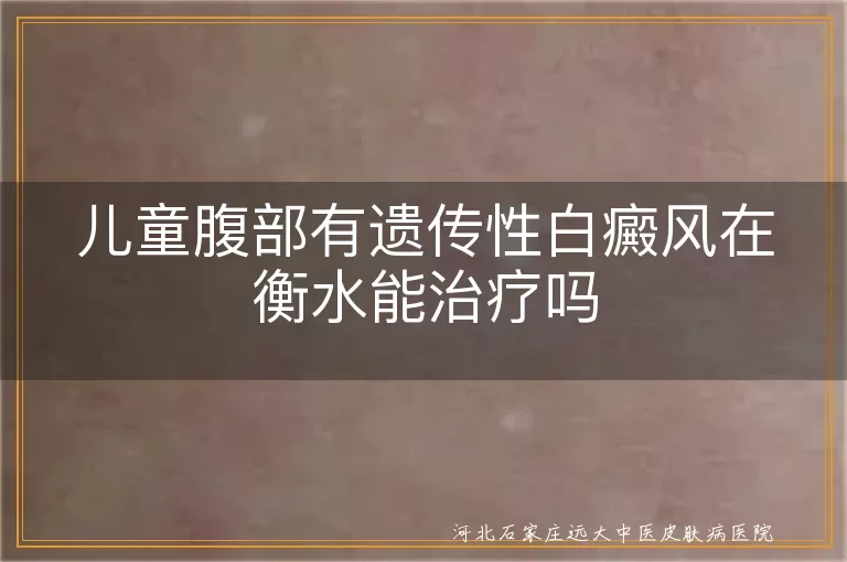 儿童腹部白癜风治疗,衡水白癜风医院,遗传性白癜风,白斑治疗
