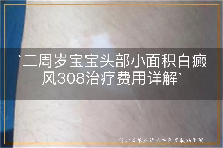 二周岁宝宝白癜风308费用,白癜风308激光治疗价格,儿童白斑308治疗花费,宝宝白斑308治疗预算