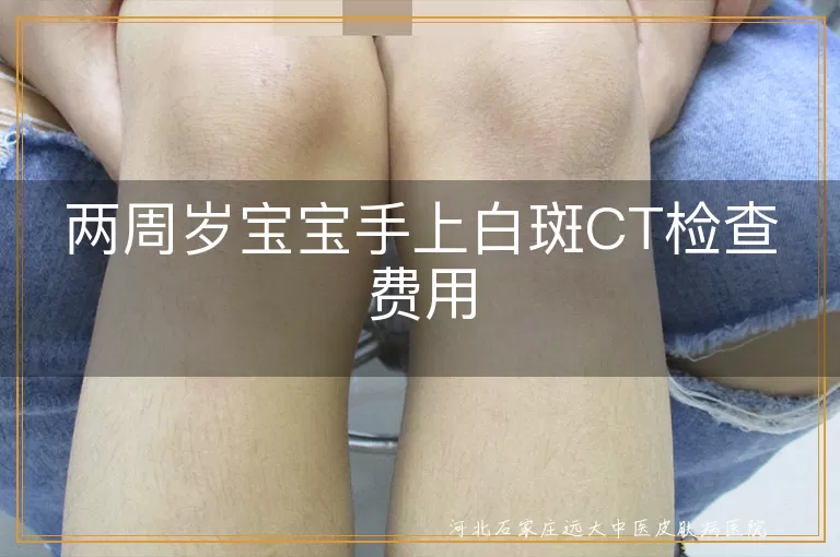 两周岁宝宝手上白斑CT检查费用,儿童白癜风检查费用,白斑CT检查费用,白癜风检查多少钱