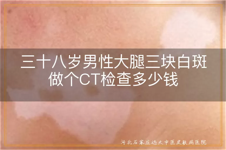 白癜风CT检查费用范围,大腿白斑皮肤CT检查价格,白斑皮肤CT检查多少钱