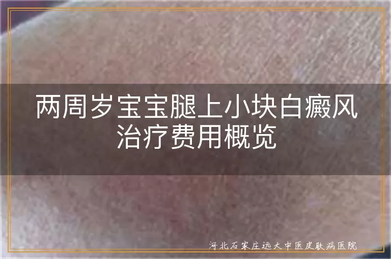 两周岁宝宝腿上白癜风治疗费用,小块白斑治疗预算,幼儿白癜风治疗开销