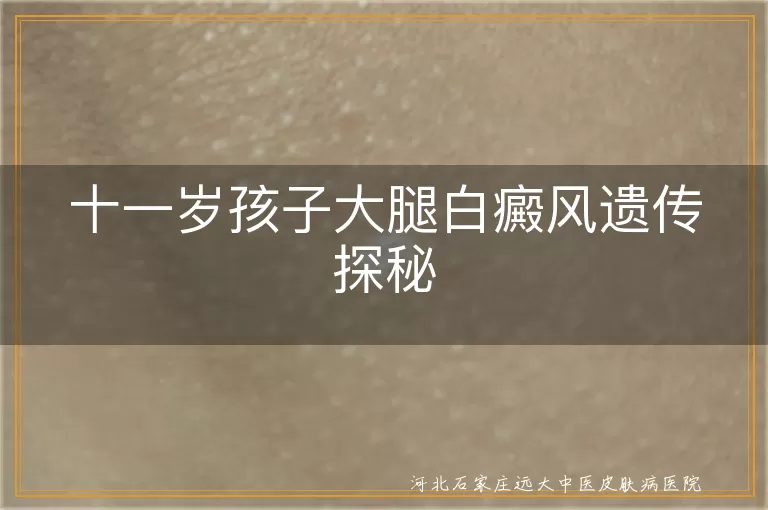 儿童白癜风遗传机制,白斑病遗传因素,青少年白癜风遗传倾向
