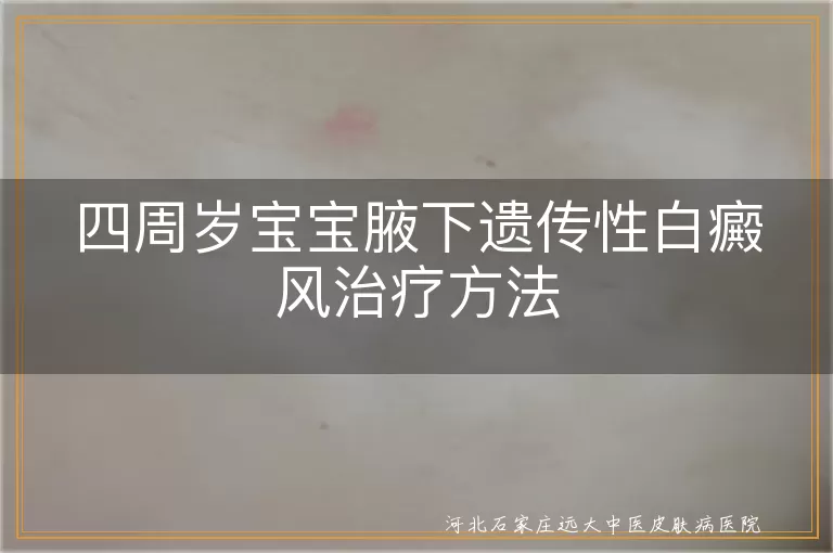 四周岁宝宝腋下遗传性白癜风治疗方法,白斑儿童治疗选择,遗传性白癜风儿童护理