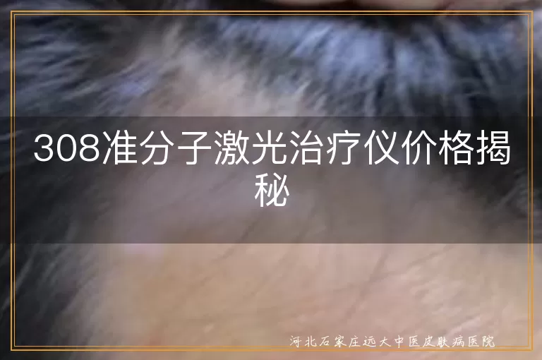 308准分子激光治疗仪白癜风价格,白斑治疗设备308准分子激光费用,308激光治疗仪白癜风多少钱