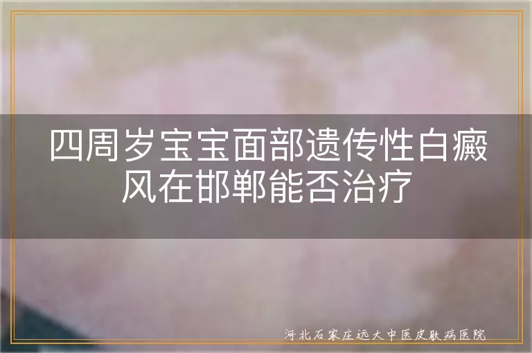 四周岁宝宝面部遗传性白癜风,邯郸白癜风医院,儿童白斑治疗方法