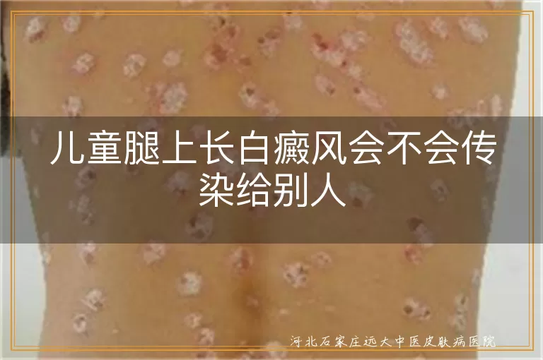 儿童白癜风传染性,白癜风发病原因,儿童白癜风治疗