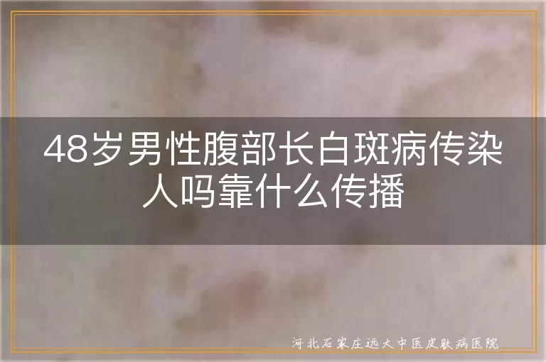 48岁男性腹部白癜风传染途径,白斑病成因复杂不传染,白斑病非传染病