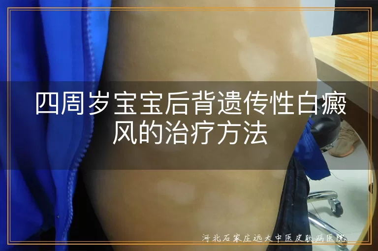 四周岁宝宝遗传性白癜风治疗,宝宝后背白斑改善方法,儿童遗传性白癜风缓解策略