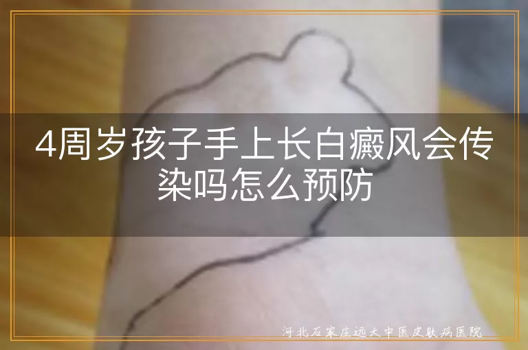 4周岁孩子白癜风预防方法,儿童白斑预防指南,幼儿白癜风预防措施