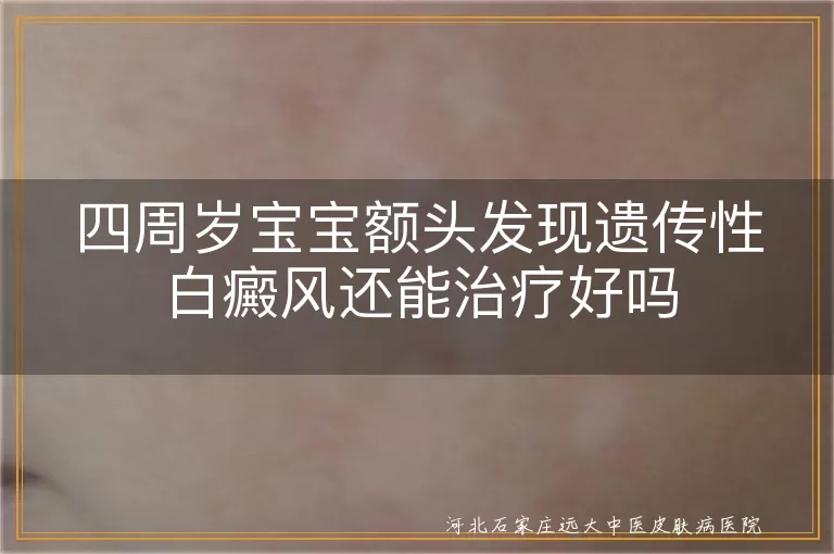 四周岁宝宝遗传性白癜风治疗,宝宝额头白斑治疗方法,儿童遗传性白斑能否治愈