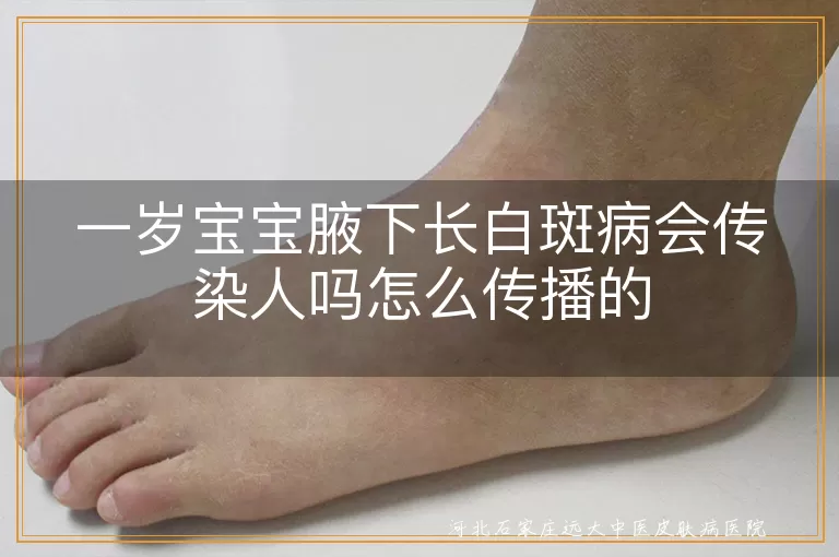 一岁宝宝白斑病会传染吗,白斑病怎么传播,白癜风儿童传染问题
