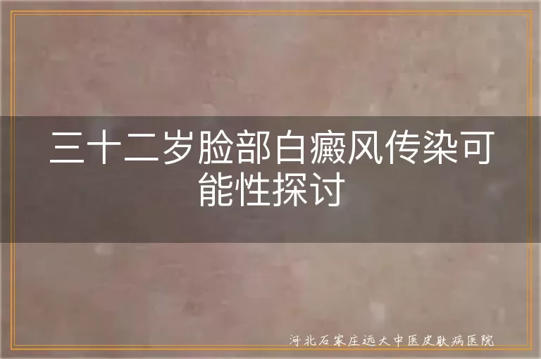 白癜风传染性,白癜风遗传倾向,白癜风患者对待方式