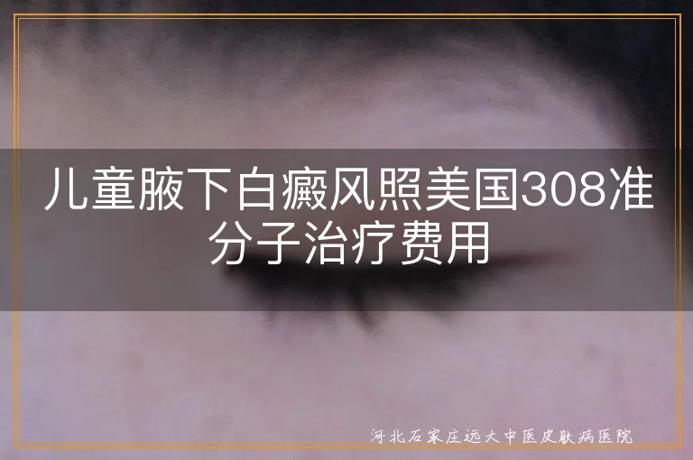 儿童白癜风治疗费用, 腋下白斑治疗费用, 308准分子治疗白癜风