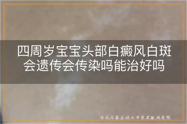 宝宝白癜风遗传风险,白斑不传染放心接触,白癜风白斑治疗方法