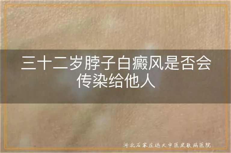 白癜风是否传染,白癜风患者接触安全,白癜风无传染性