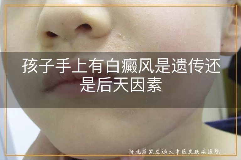 孩子白癜风遗传后天因素,11岁孩子白斑成因,白癜风发病因素