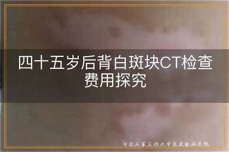 白癜风CT检查费用,白斑块诊断费用,中年白癜风检查价格