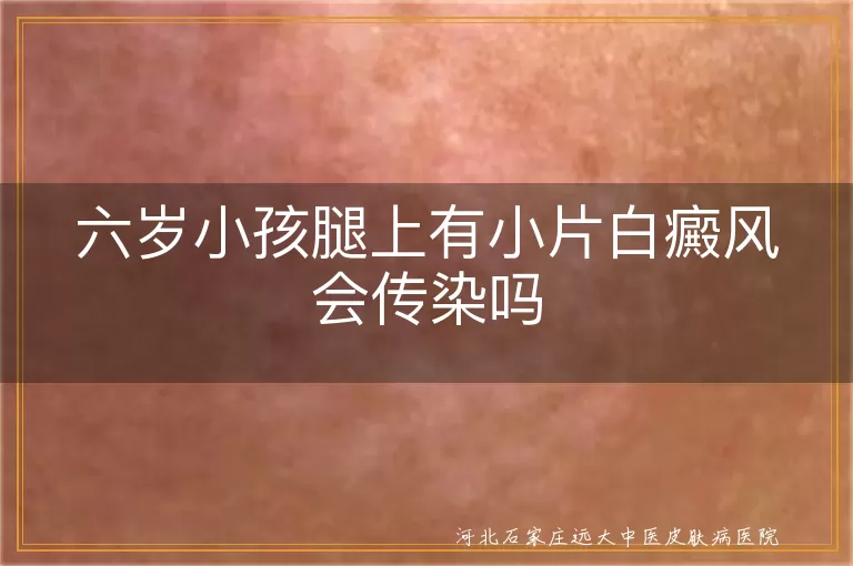 六岁小孩白癜风传染疑问, 儿童腿部白斑传染性探讨, 白斑皮肤病传染性问题解答