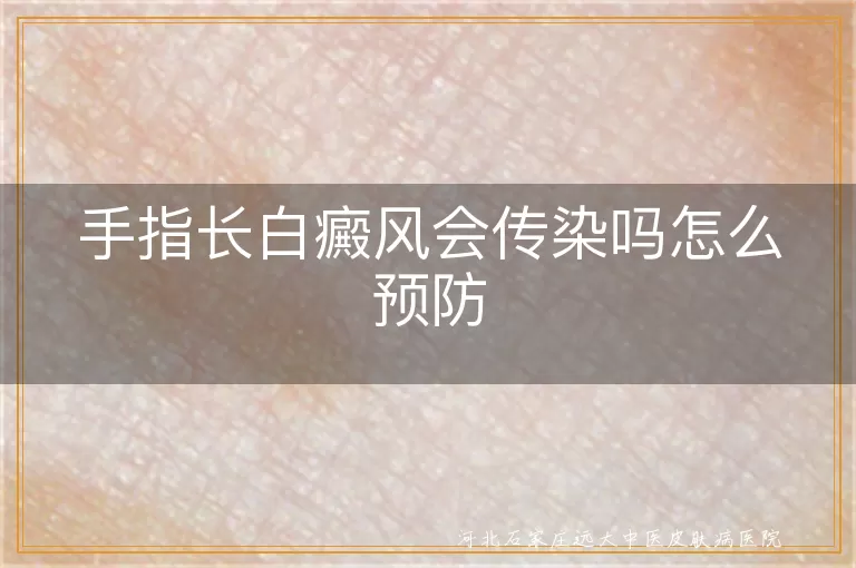 手指白癜风预防方法,白斑病预防,白癜风预防措施