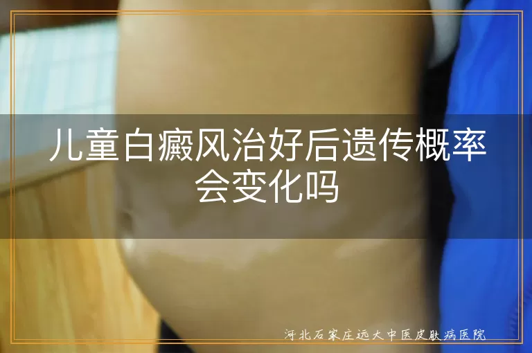 儿童白癜风治好后遗传概率会变化吗
