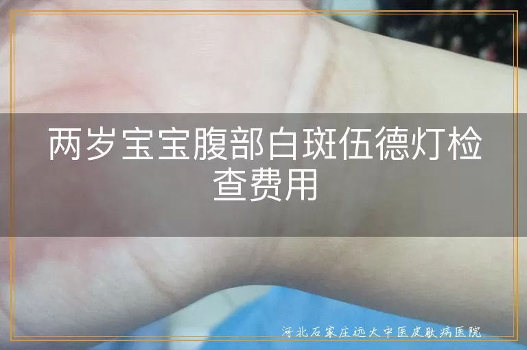 两岁宝宝白斑检查费用,伍德灯检查白癜风,白斑病治疗价格