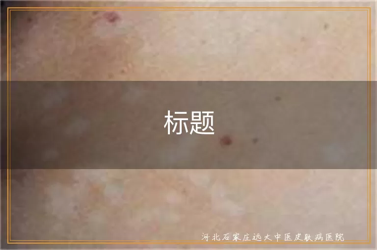 邢台宝宝白癜风治疗医院,两岁儿童白斑治疗,遗传性白癜风邢台就医