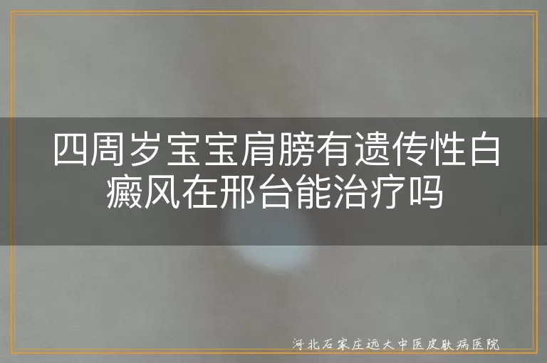 邢台治疗儿童白癜风医院,四岁宝宝遗传性白斑治疗,儿童遗传性白癜风治愈案例