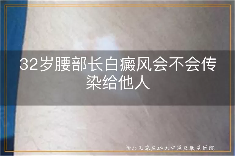 白癜风传染性,腰部白癜风治疗,白斑预防方法