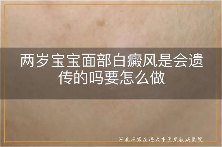 两岁宝宝白癜风遗传风险,宝宝面部白斑治疗护理,白癜风宝宝日常护理要点