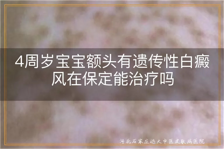 保定治疗遗传性白癜风,4岁宝宝白斑治疗,儿童白癜风治疗方法
