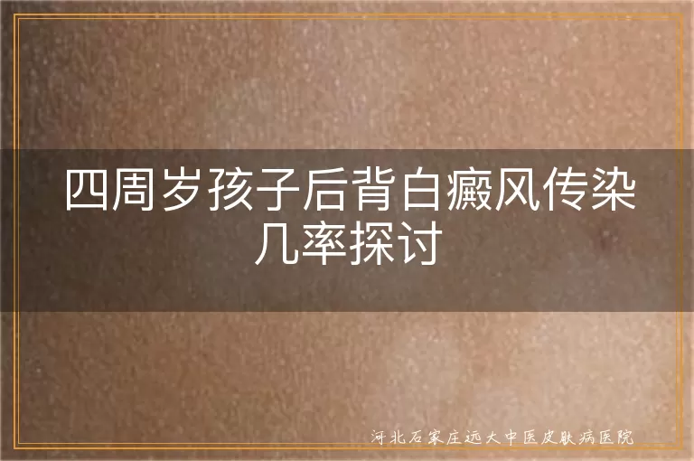 四周岁孩子白癜风传染性,儿童白癜风传染几率,幼儿白斑病传染问题