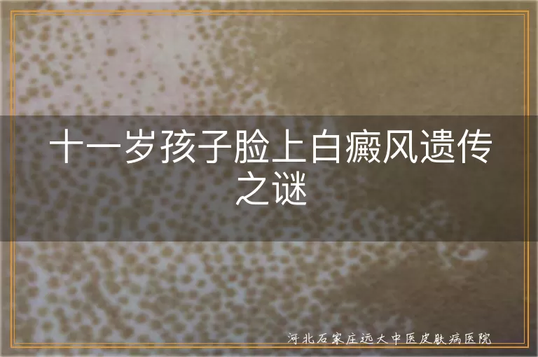 白癜风遗传模式揭秘,孩子白斑遗传原因探析,白斑遗传风险与预防