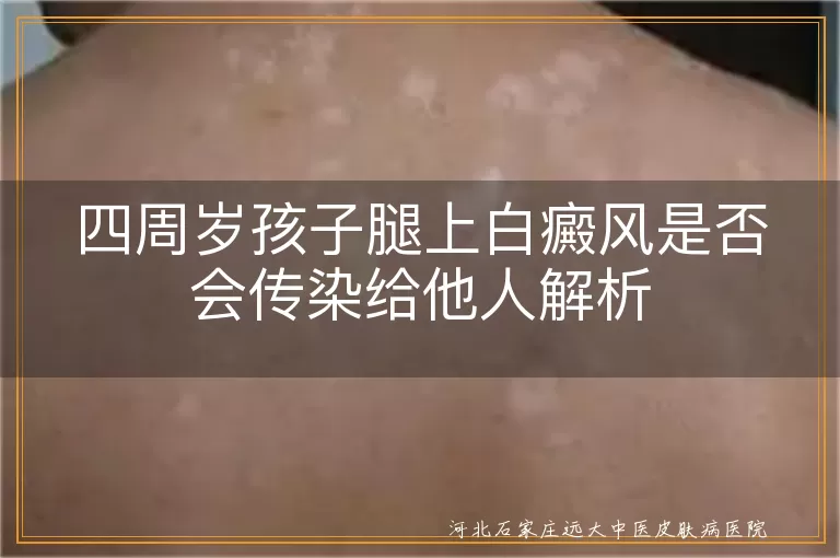 四周岁孩子白癜风传染性,儿童白癜风是否会传染,白癜风白斑不传染