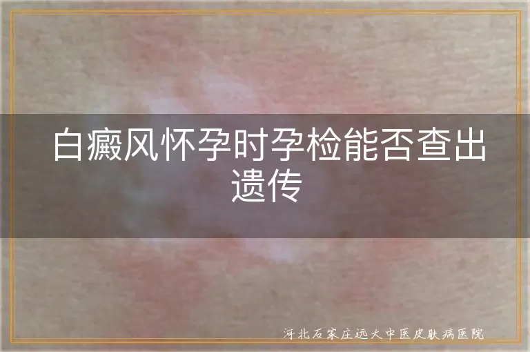 白癜风怀孕遗传风险,白斑孕检能否查出,白癜风生育注意事项
