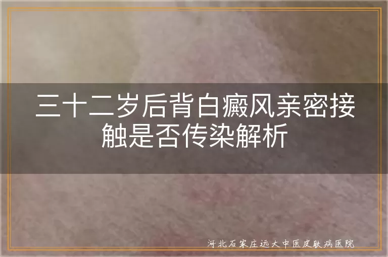 白癜风是否会传染,白癜风亲密接触安全,白癜风患者注意事项