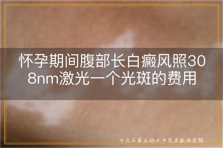 怀孕期间白癜风照308nm激光费用, 腹部白斑激光治疗价格, 孕期白癜风治疗一个光斑多少钱
