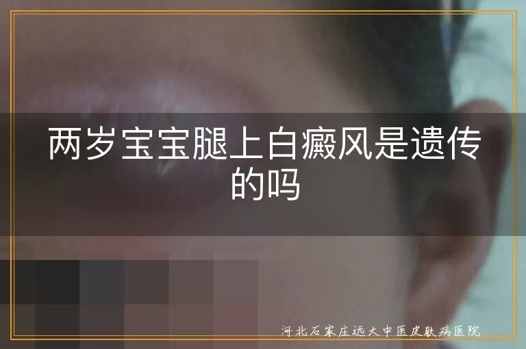 两岁宝宝白癜风遗传吗,儿童白癜风发病原因,宝宝白斑如何护理
