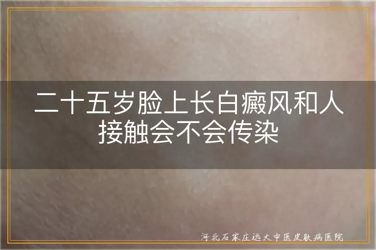 白癜风是否会传染,二十五岁白斑原因,与白癜风患者相处