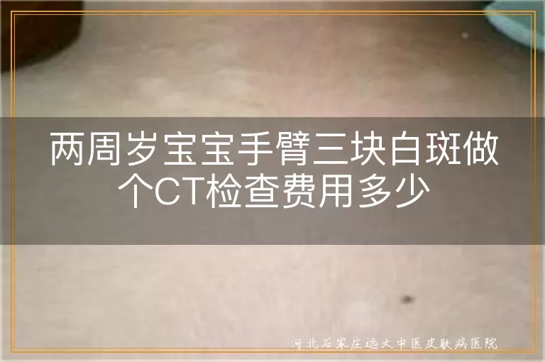 两周岁宝宝白癜风CT检查费用, 宝宝白斑皮肤CT检查多少钱, 儿童白斑检查费用白癜风